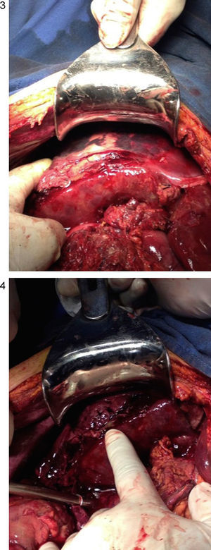 Subcapsular haematoma rupture in right liver lobe.