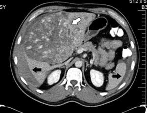 Abdominal axial CT scan with oral and intravenous contrast enhancement in arterial phase which shows liquid fluid in the abdominal cavity, predominantly perihepatic and perissplenic (black arrows) and a rounded tumour, heterogeneously contrasted, which occupies practically the entire liver (white arrow).