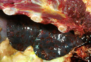 Pulmonary parenchyma where metastatic tumours are noted, which are punctiform and haemorrhagic.