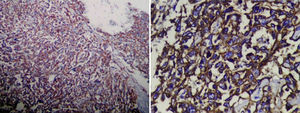 Histology, endothelial cells which are grouped into strands, invading vascular spaces and which test positive for CD31 and CD34.