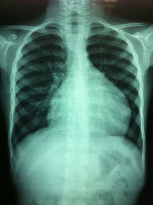 Chest X-ray showing enlarged cardiac silhouette.