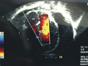 Ultrasound with radiolucent image, compatible with a pericardial effusion of approximately 500ml.