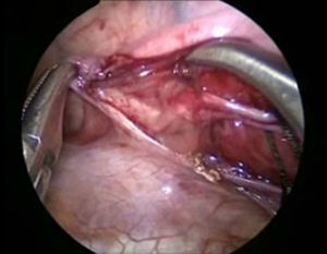 Thoracoscopic image. The thoracic duct can be observed at the time of dissection.