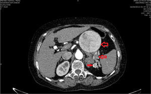 Computed contrast tomography showing 3 lesions, the first 8cm in diameter (thick arrow), the second 3.4cm (medium arrow) and the third 1.6cm (thin arrow).