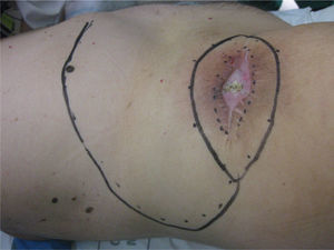 Area of recurrence surrounded by radiodermatitis. Marking of broad excision, and design of flap for cover.