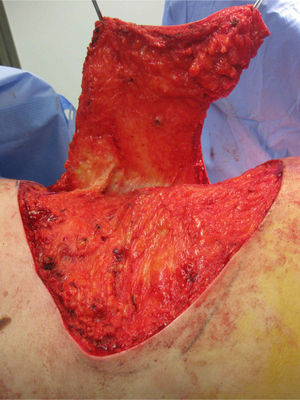 Intraoperative image of lifting of the flap.
