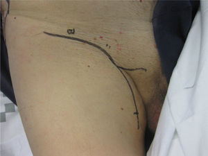 Design of right inguinal lymphadenectomy.