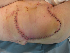 Postsurgical result.