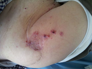 Lesions compatible with recurrence adjacent to the flap scar.