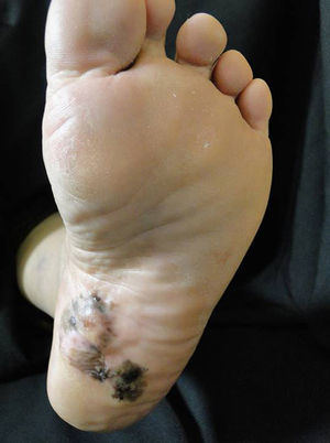 Patient with plantar acral melanoma.