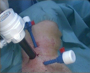 Positioning of the trocars in the neck.