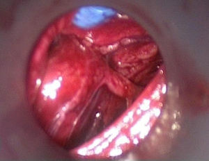 Endoscopic exposure.