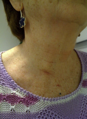 Aesthetic result one month after surgical intervention.