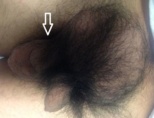 25cm×25cm increase in volume in the right inguinal scrotal region. Arrow: increase in volume in spermatic cord region.