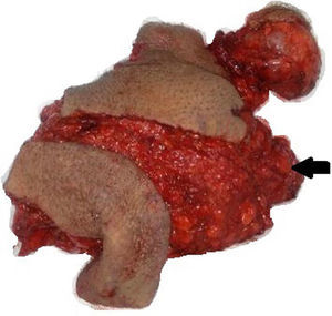 Computed tomography of the abdomen and pelvis with heterogeneous increase in volume of 114 to 42 UH. Arrow on left side: origin of tumour of the spermatic cord. Arrow on the right side: great size of the tumour in the suprapubic region.