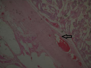 A benign lesion is identified with vascular channels of diverse calibre, hialinsed wall, flat endothelium and congestive lights. The arrows indicate the vascular component with erythrocytes.