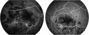 Fluoroangiographic image in the early phase of both macular areas. In this phase of the study some areas with hypofluorescence can be seen in areas corresponding to the lesions present in the clinical photographs.