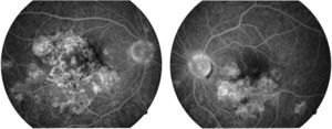 Fluoroangiographic image in the late phase of both eyes. Hyperfluorescent areas can be seen in some of the areas which previously, in the early phases of the study, were hypofluorescent in both eyes. This change from early hypofluorescence to late hyperfluorescence of the lesions is characteristic of acute posterior multifocal placoid pigment epitheliopathy lesions.