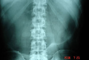 Simple abdominal radiography showing a high elevation of the left hemi-diaphragm, with gastric dilatation.