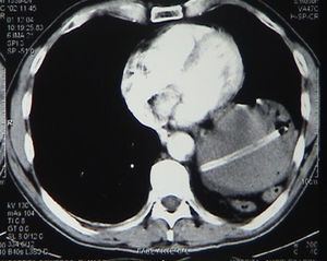 Thoraco-abdominal tomography with gastric ascent into the thoracic cavity. The diaphragm is not identified.
