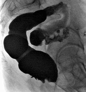 Opaque enema shows a diverticular image of 2cm in depth in the most caudal section of the rectal ampulla.
