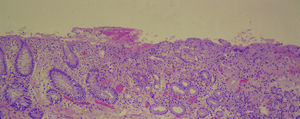 Histological section presenting the transition between antropyloric gastric mucosa without atypia (to the left of the image) and colonic-type mucosa with Lieberkuhn crypts (to the right of the image).