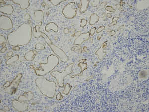 Well delimited nodular tumour formed by multiple lymphatic capillaries which show marked positivity with the D2-40 immunohistochemical stain (stain, 4×).