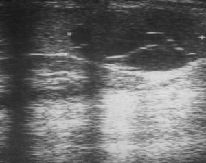 Ultrasound showing a macrocystic splenic lesion, of 1.2cm×1.4cm (case 2).
