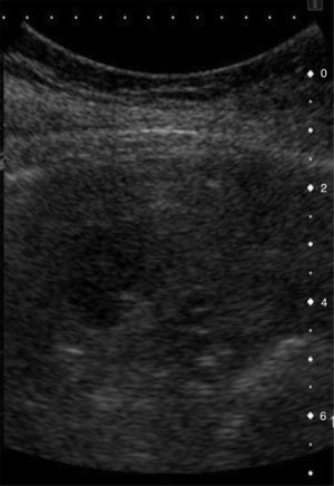Contrast ultrasound showing various “nodules” in the spleen, corresponding to the lesions described in case 3.