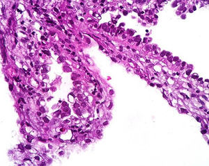 Tumour showing a tubulocystic and papillary pattern with lined cystic spaces, polygonal tumour cells of clear cell cytoplasim with nuclear pleomorphism and studded and clear cell carcinoma (haematoxylin and eosin).