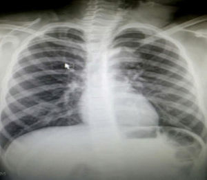 X-ray of the neck. There is no obvious lesion on the neck or on the mediastinum or parenchyma.