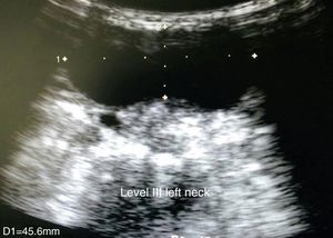Ultrasound imaging of the neck. No cystic lesion is observed nor level III lymph nodes on the neck.