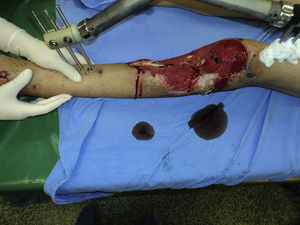 Female aged 30. Motorcycle accident with extensive lesion of soft tissues, with major loss of the middle third and proximal tibia.