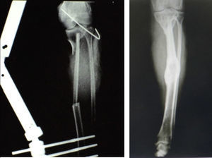 Radiography 2 weeks (left) and 3 years (right) after surgery. 3 years after initial surgery complete integration was observed and marked hypertrophy of the fibula flap in the receptor bed with an almost equal diameter in total to that of the tibia.