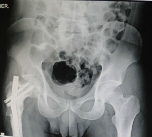Male aged 36, with insufficient consolidation in the femur due to a fracture at resection site, 15 years previously, of a Ewing sarcoma. Fracture in pathological site with breakage of centromedullary pin.