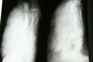 X-ray of the foot: complete absence of the 4th and 5th digits, with partial destruction of the cuboid bone, the 3rd cuneiform bone and fracture of the proximal phalanx of the 3rd toe. Marked increase in density of the tissue of the soft tissues adjacent to the bone involvement.