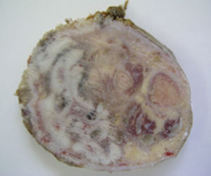 Tumorous tissue affecting the tarsus and the soft tissues.