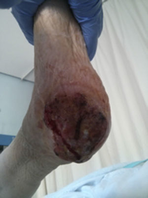 Ulcer on the right heel, stony to the touch, friable and with associated cellulitis in the sole of the foot.