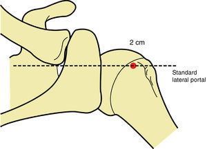 Anatomical location of the standard lateral portal.