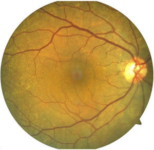 Clinical image of posterior pole of the right eye.