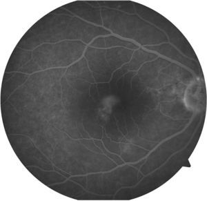 Fluorescein angiography of the right eye in the later stages.