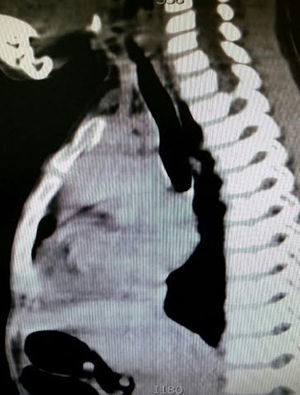 CAT scan, lateral slice. A large heterogeneous mass is noted extending from the neck, superior and anterior mediastinum, with minimum compression of airway.