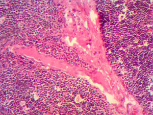 Histological image with HE staining where the loss of normal structure is noted, with no medullary residues and with a network of large neoplastic cells, with large vesicular nuclei, and prominent nucleoli in the network of vessels and septa, and with scattered immature lymphocytes around the blood vessels.