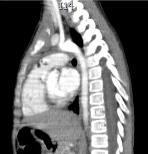 Control CAT scan, with no evidence of a tumour, aorta with no obstruction.