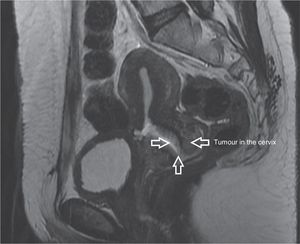 Nuclear magnetic resonance imaging showing uterine cervix tumour (arrows).