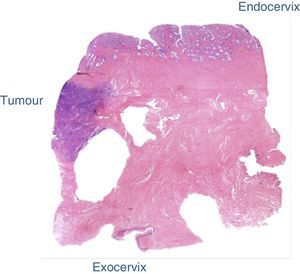 Histological cross-section of the cervix, showing the tumour between the endocervix and the exocervic; haematoxylin/eosin.