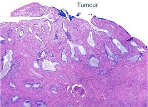 Histological cross-section of the tumour, haematoxylin/eosin.