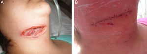 Patient with vacuum-assisted closure therapy. (A) Prior to therapy administration. (B) Closure of wound after 22 days.