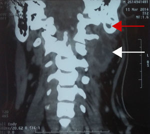 Coronal plane of contrasted computed tomography of the neck showing a purulent collection in the deep spaces of the neck (white arrow) and signs of ipsilateral mastoiditis (red arrow).