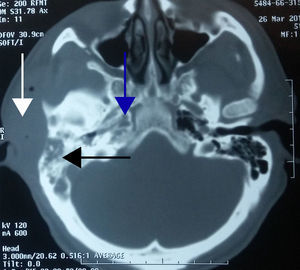 Showing the right mastoid (black arrow) and the ipsilateral petrous apex occupied by an isodense image (blue arrow), and soft tissue abscess (white arrow).
